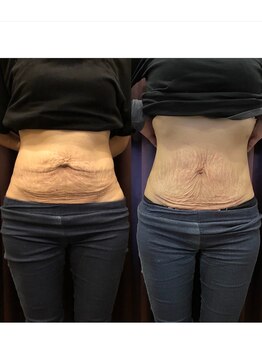 長寿鍼灸院 長寿整骨院/EMS<お腹集中コース>