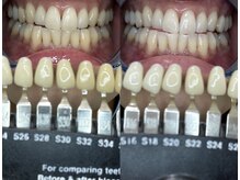 トウキョースワーズ 渋谷店(TOKYO SWRS)/#ホワイトニング #渋谷 #池袋