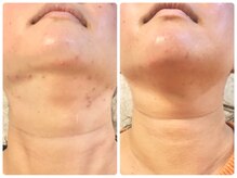 ラウン 京都(ROUN')/約半年の施術ビフォーアフター