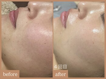 リムーン 岡崎(Re'moon)/REVI ハーブピーリング