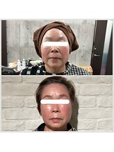 ユメサロン(Yume Salon)/肌質激変◎水光肌VOSピーリング