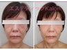 【目元・口元・フェイスラインのタルミ改善！】最新美容で老け見え解消♪