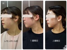 プリオール 太田店(Prior)/エステダーマレモンボトル