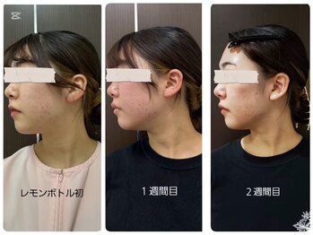 プリオール 太田店(Prior)/エステダーマレモンボトル