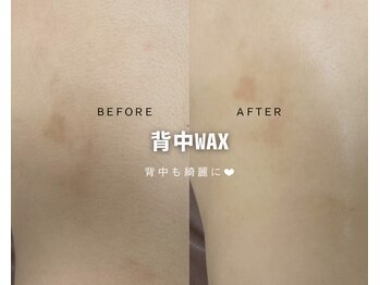 ルナソルビューティーサロン 浜松店(Lunasol)/背中 MIX脱毛♪