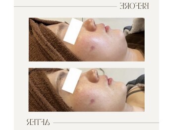 マオ(mao)/☆3回Before→after☆