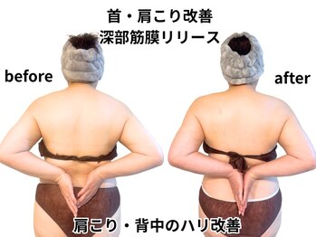 アルピナ(ALPINA)の写真/首・肩こり改善!深部筋膜リリースで一撃リセット