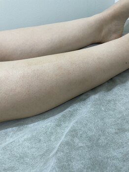 ナノハナ/鹿沼市の全身脱毛のナノハナ