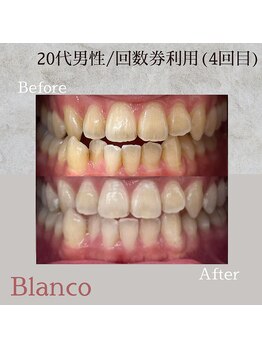 ブランコ 川口店(Blanco)/メンズ☆セルフホワイトニング