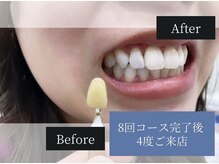 ホワイトニングカフェ 白山店(WhiteningCafe)/◎歯のホワイトニング施術写真◎