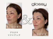 グロッシー(glossy)/【症例】プラズマ全顔リフトケア