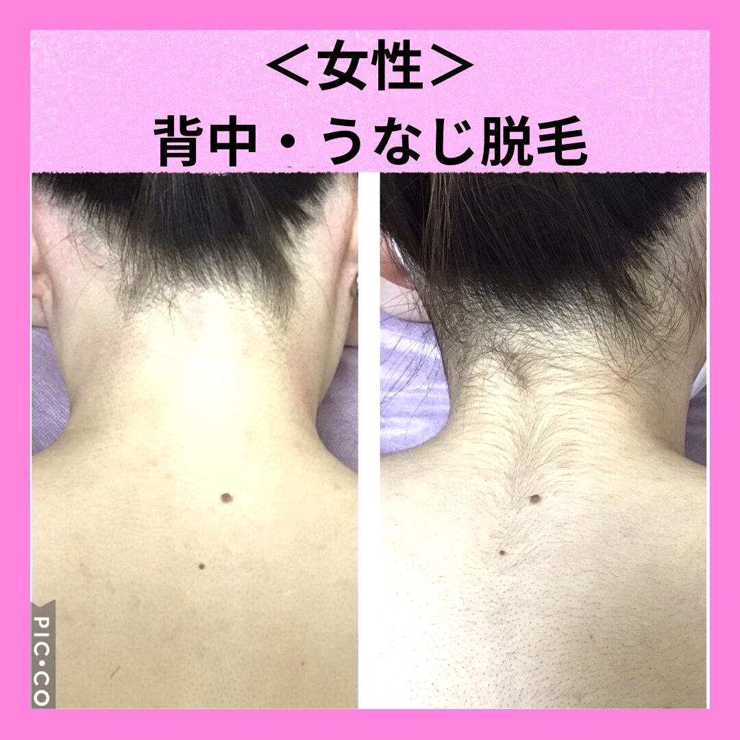 【女性脱毛】実は見られている！うなじ＆背中　似合わせシェービング付き