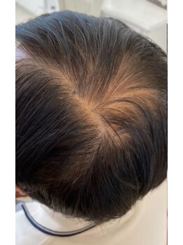 フォーケア(4Care)/プロセル頭皮改善トリートメント