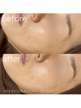 ルルラ リコ(lulula rico)/症例写真/ハーブピーリング