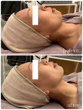 メゾンリュバン 梅田店(Maison Ruban)/エステ版オンダリフトプロ