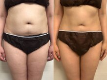 ジュメル 恵比寿店(Jumelles)/ぽっこりお腹がスッキリ！