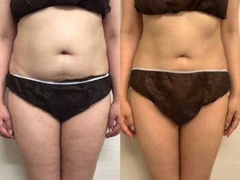 ジュメル 恵比寿店(Jumelles)/ぽっこりお腹がスッキリ！