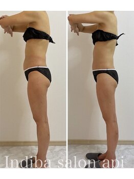 アピ(api)/症例写真【インディバ】