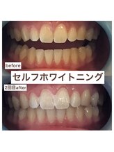 エスデザイン(es design)/セルフホワイトニング／鹿児島