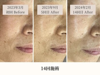 イト(ito)/しわ、くすみでお悩みの方に