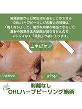 ティンクルホワイト 上尾店/ハーブピーリング施術後