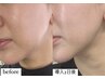 【お顔】半永久的効果！韓国発◎脂肪分解剤ダウンタイムなし！¥9,800→¥7,980