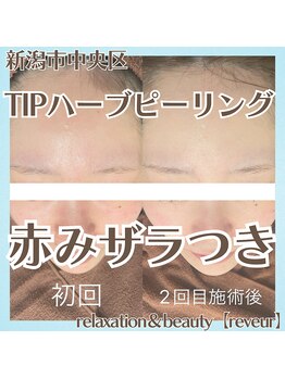 レヴール(reveur)/ハーブピーリングで美肌ケア