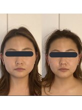 ハイコガオ 中崎町店(HIKOGAO)/小顔矯正