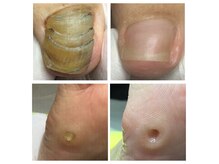 【フットケア専門店】巻き爪-肥厚爪-タコ魚の目-角質-リフレ