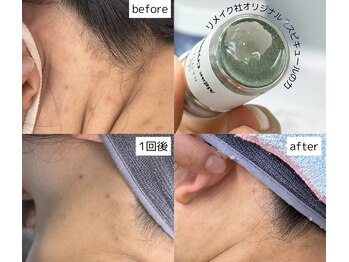 リメイククリニカルビューティー(Remake clinical beauty)/原因不明の赤み、凹凸