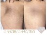 大人気【背中ニキビケア/跡】上半分/最高級★剥離有ハーブピーリング¥60000→