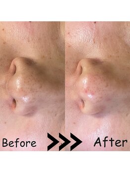 ゆしんアネックス/全顔毛穴洗浄ビフォーアフター☆