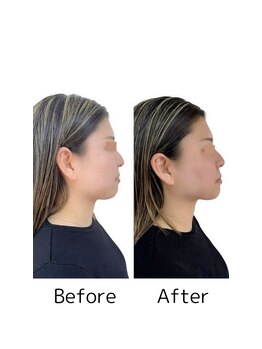 カノア(KANOA)/お顔のぽにょ取り