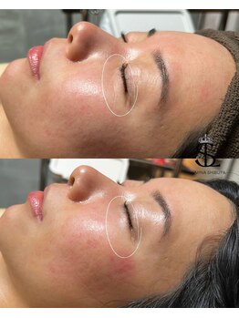 ルミナ シブヤ(LUMINA SHIBUYA)/【小ジワ】プラズマ1回目