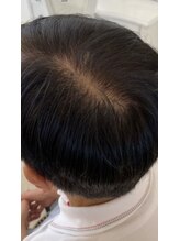 フォーケア(4Care)/プロセル頭皮改善トリートメント