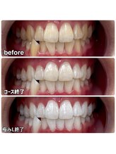 ティースペース(T-space)/極みライト