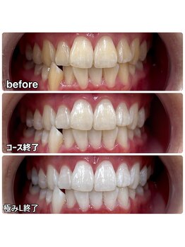 ティースペース(T-space)/極みライト