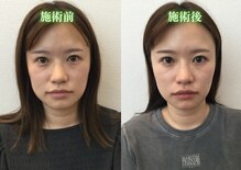 アプレシエ(Apprecier)