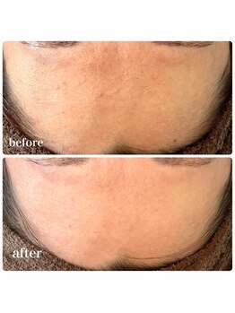 美温(mion)/ハーブピーリング