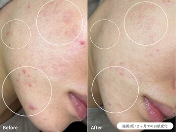 フォンビューティー(fon beauty)/2ヶ月でのお肌変化♪