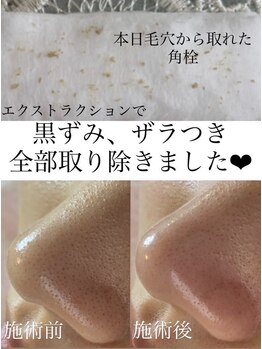 ジュエルオーキッド(Jewel orchids)/毛穴エクストラクションtete式