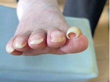 巻き爪じゅん　津田沼駅前店　【副爪/肥厚爪/深爪/フットケア】/