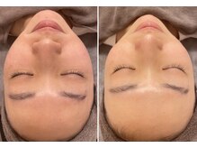 プティアンジュ(Petit ange)/脱毛しながら美肌が叶う