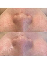 ハクビ(HAKUBI)/毛穴改善