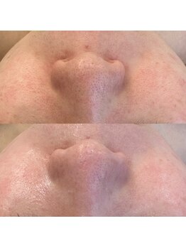 ハクビ(HAKUBI)/毛穴改善