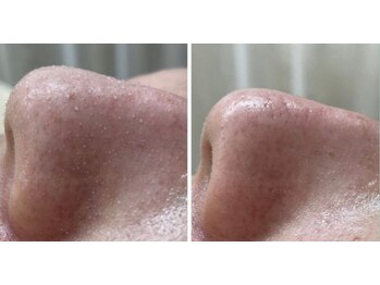 アップル 宇都宮店(Apple.)/毛穴ケア