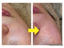 アルマ(ALMA)/毛穴ふっくらで毛穴レスな肌に