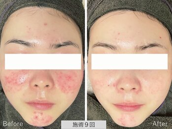 ニキビ研究所 千葉店/思春期ニキビ・大人ニキビケア