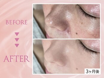 クリアラボ 池袋2nd(Clear Lab)/韓国肌管理&毛穴洗浄専門店