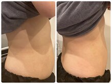 リズ(Liz)/30代女性 &nbsp;お腹の施術